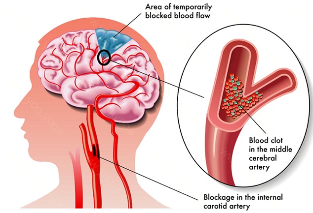 Brain Stroke Cure and Treatment in Lucknow Uttar Pradesh