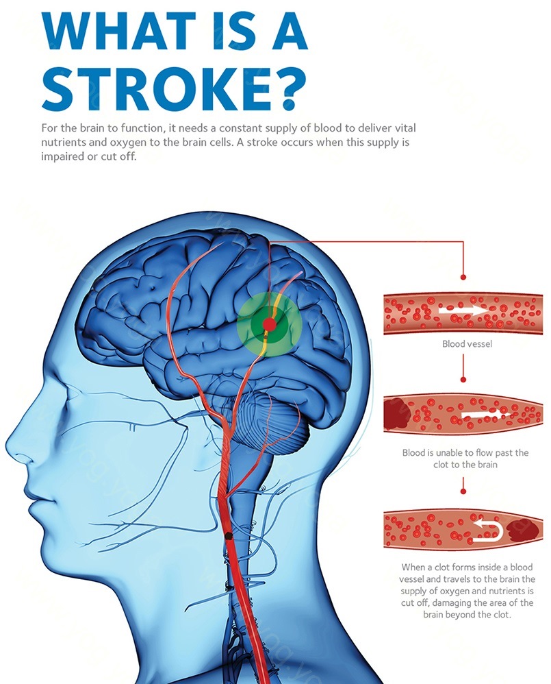 Brain Stroke Cure and Treatment in Lucknow Uttar Pradesh