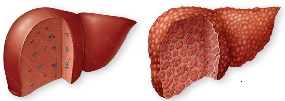 Liver Disease Cure and Treatment in Visakhapatnam Andhra Pradesh