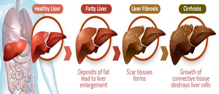 Liver Disease Cure and Treatment in Visakhapatnam Andhra Pradesh